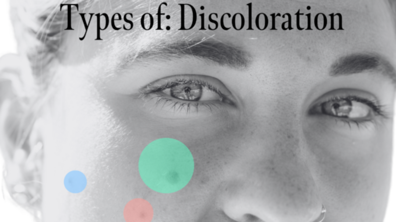 discolorationblogheader2560-x-1652-px-620x400.png